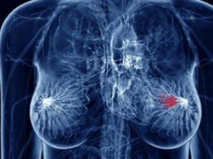 Откриха лекарство за нелечимия рак на гърдата