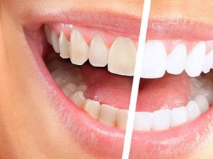 Збравете зъболекаря! 8 храни за бели и здрави зъби