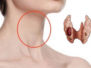 Как се „маскират“ болестите на щитовидната жлеза 

