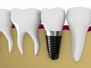 Как се поставят зъбни импланти