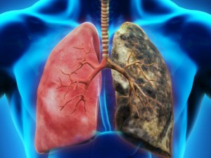 Ракът на белия дроб най-честото онкозаболяване у нас