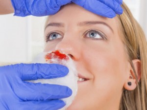 Как да спрем кървенето от носа