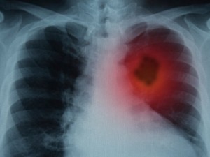Над 4 хил. годишно се разболяват от рак на белия дроб