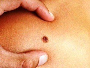 Ето кои бенки са предвестници на рака 
 