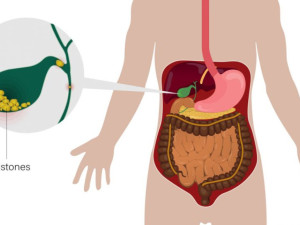 Преборете жлъчните камъни с богати на фибри храни
